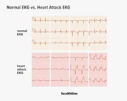 electrocardiogram (ECG or EKG) showing a heart attackの画像