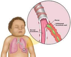 Immagine di baby with bronchiolitis