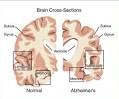 Maladie d Alzheimer Dix signes prcoces