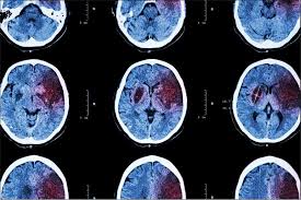 Improving Access to Optimal Acute Care for Women with Acute Ischemic Stroke - 1