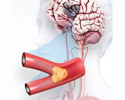 Image of Ischemic stroke