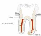 Kunststofffüllung im Zahn - Zahnärzte beraten Sie gern