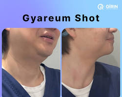 نتائج إبر إذابة الدهون الذقن قبل وبعد الرياض, AI generated