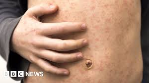 Outbreak Alert: Stoke-on-Trent School and Nursery Connected to Seven Measles Cases - 1