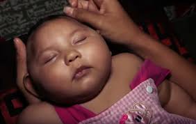 Image result for pictures of zika babies