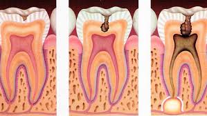 Resultado de imagen para caries dentales