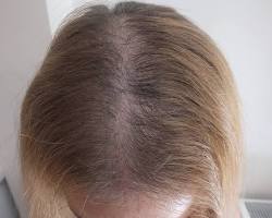 Image of Telogen Effluvium hair loss