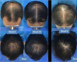 Image of Efficacy of lowlevel laser therapy in the treatment of alopecia areata