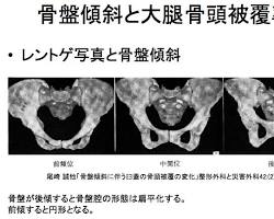 骨盤前傾と後傾による股関節被覆の変化を示す模式図の画像