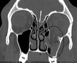 Picture of Orbital blowout fracture