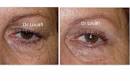 Blpharoplastie (chirurgie esthtique des paupires) Paris