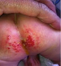 Image result for newborn diaper rash