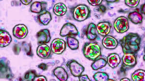 Two deaths reported in Pennsylvania measles outbreak