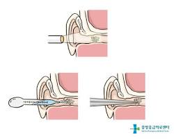 귀에 이물질
