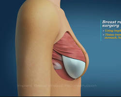 Image of Breast reconstruction with implants