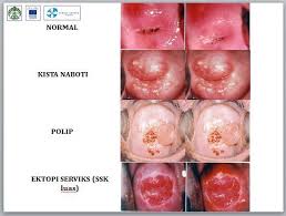 `penyakit kanker serviks