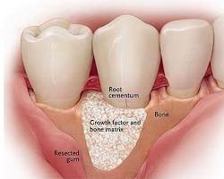 Image of regenerative dentistry procedure