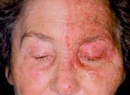 Image result for "Herpes Zoster"