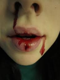 Nose Bleed by nocturnal-lemur - nose_bleed_by_nocturnal_lemur-d4ljj2k