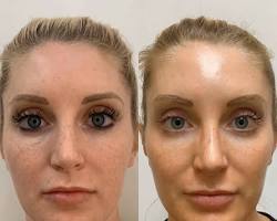 microneedling with prp before and after results faces, AI generated