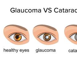 Image of glaucoma eye
