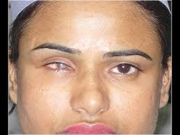 Image result for eyeball enucleation cattle