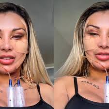 Andressa Urach gasta R$ 100 mil em cirurgia para voltar a ter 20 anos