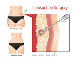 Image of VASER Liposuction procedure