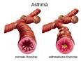 Was wirklich gegen akute Bronchitis hilft - DIE WELT