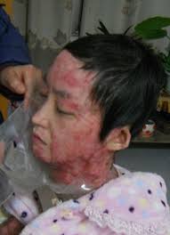 Zhou Yan receives treatment for her burns. Painful rehabilitation: Yan&#39;s parents could not afford the medical bills for her treatment, so they were reliant ... - article-2440034-186D86E700000578-482_306x423