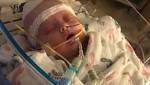  Baby hit by softball treated for fractured skull, brain bleeds