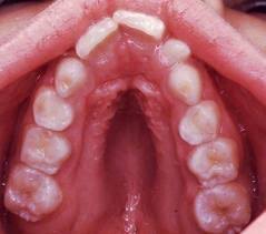 Image result for v shaped maxilla