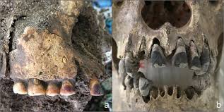 A kingdom with blackened teeth 2,000 years ago: tracing the practice of tooth blackening in ancient Vietnam | Archaeological and Anthropological Sciences | Springer Nature Link