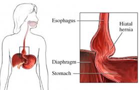 Hernia Hiatal