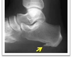 足底筋膜炎のレントゲン写真の画像