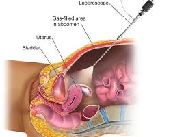Image of Laparoscopic surgery
