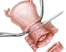 Hình ảnh về Phẫu thuật ung thư cổ tử cung