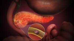 Picture of acute pancreatitis