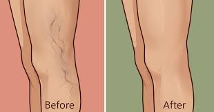 Image result for varicose veins