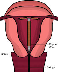 Image result for IUD image