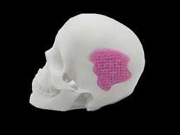 Vidrio creado por impresión 3D para reemplazar huesos ...