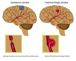 Image of Stroke brain