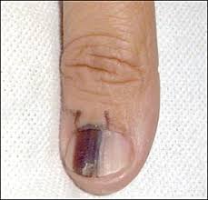  Black Spot Under The Toenail