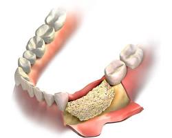 Autograft bone grafting for dental implants