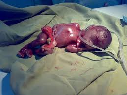 Hasil gambar untuk makalah abortus