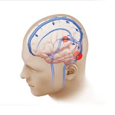 Some instances of pseudotumor cerebri may be caused by a narrowing (red circles) in the veins that drain blood from the brain (blue). - pseudotumor-cerebri-trial-2-lg