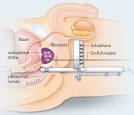 Bestrahlung prostatakarzinom