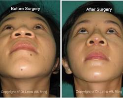 Image of Revision Alarplasty Procedure