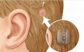 Resultado de imagen de implante coclear niños