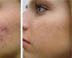 Image of patient with acne scars and hyperpigmentation before a chemical peel